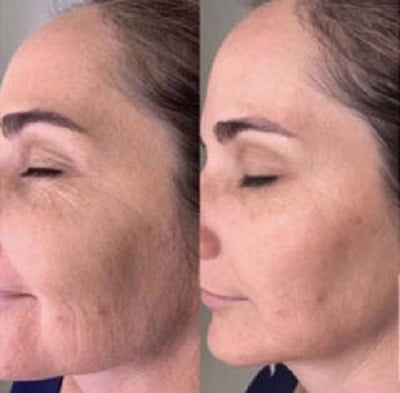 DG Máquina Lifting Facial